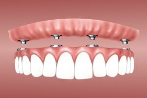 professional dental implant sales all-on-x full-arch implants