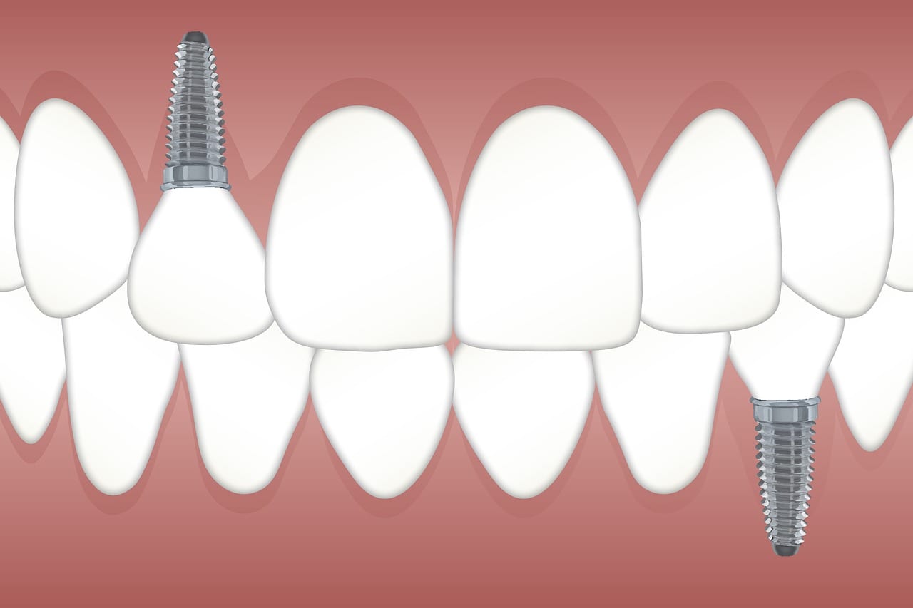 professional dental implant sales